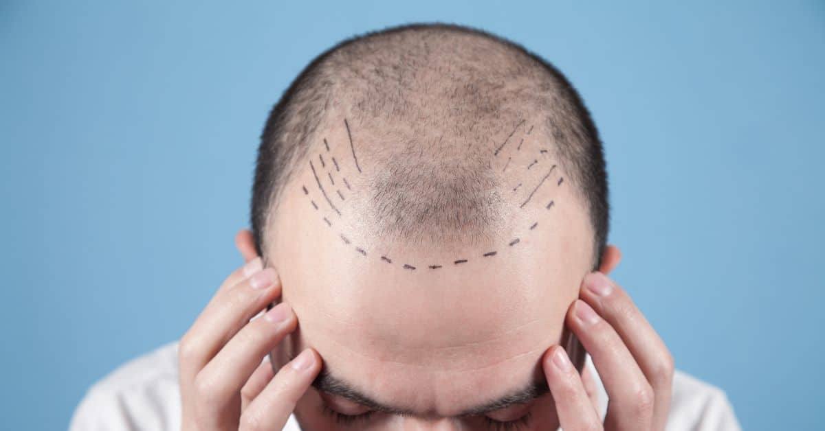 רופאים מומלצים להשתלת שיער