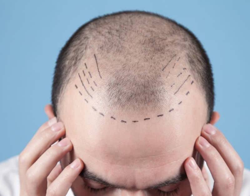 רופאים מומלצים להשתלת שיער